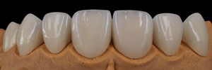 Owngrin litio disilicato di vetro dentale in ceramica dentiera denti finti impiallacciatura ceramica impianti di porcellana dentale corona dente - Product Image 3