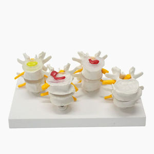 인간 척추 모델에서 정상 요추 및 4 단 요추 디스크 허리 병변 모델 - Product Image 1