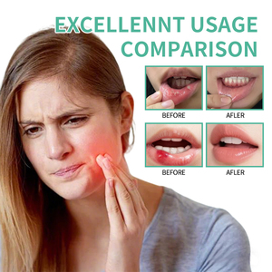 <span class=keywords><strong>Gel</strong></span> Bucal Portátil con Hierbas Antibacterianas para Aliviar el Dolor de Muelas, Dolor Oral, Dolor Periodontal, Úlceras Aftosas y Ampollas - Product Image 6