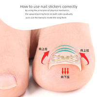 Correcteur d'ongles incarnés invisible en forme de X, léger, en alliage de nickel, auto-adhésif, pour l'hiver, vente en gros