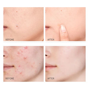 Patch cicatrisant pour l'acné et les boutons, marque privée, soin de la peau invisible, acide hyaluronique, patch pour l'acné et les boutons - Product Image 6