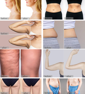 <span class=keywords><strong>Appareil</strong></span> de remodelage corporel à triple applicateur <span class=keywords><strong>pour</strong></span> le soin des graisses et le raffermissement - Product Image 5
