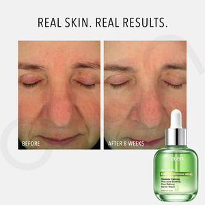 Sérum facial à l'acide azélaïque Oalen Private Label, hydratant, soin des imperfections, réduit les rougeurs de la <span class=keywords><strong>peau</strong></span>, adapté aux peaux sensibles et grasses - Product Image 5