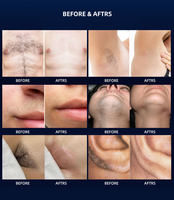 Boslaser Bella Derma Laser, machine d'épilation au laser, appareil d'épilation au laser professionnel, épilation définitive, promotions