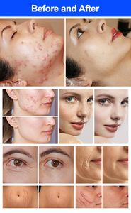 เครื่องมัลติฟังก์ชั่นความงาม เลเซอร์ CO2 แบบ Fractional อุปกรณ์ความงาม ABS สำหรับการฟื้นฟูผิวหน้า กำจัดสิว รอยแตกลาย สำหรับร้านเสริมสวย - Product Image 2