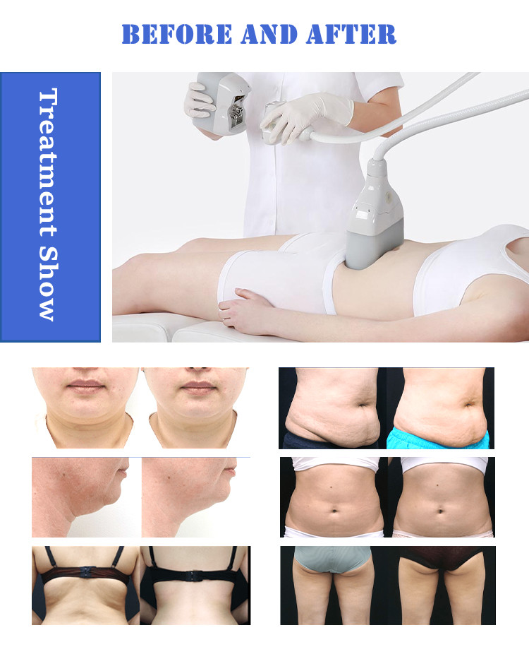 Home use professional cryo lipo cryotherapy machine fat reduction for body sculpting slimming machine