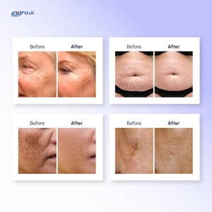 מכונת יופי cur2 לייזר עור מכונת עור עור מחדש אסתטי מקצועי - Product Image 5