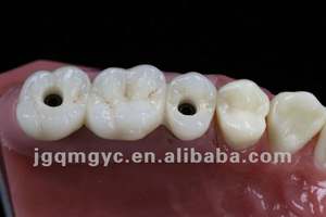 Geschroefd Implantaat Ondersteund Hybrident Kunstgebit Titanium Bar Zirconia Kronen Hoge Nauwkeurigheid China Tandheelkundig Lab - Product Image 6
