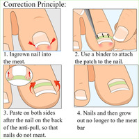10 pièces/boîte boîte transparente 3mm/3.5mm/4mm Patch de Correction des ongles incarnés outil de pédicure traitement des ongles