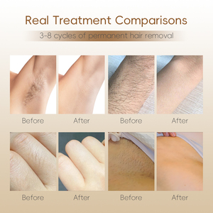 DF-AI Analyse de la peau Diode Épilation au laser Triple vague 755/808/1064nm 4K Écran tactile Équipement de beauté commercial - Product Image 6