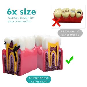 Modelo Educativo Dental: Comparación Bilateral de Caries, Modelo de Demostración Transversal 6 Veces Ampliada, Accesorios para la Enseñanza de la Decidencia Dental - Product Image 3