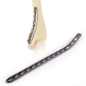 CANWELL Pelat Pengunci Titanium Medial <span class=keywords><strong>Distal</strong></span> <span class=keywords><strong>Humerus</strong></span> untuk Tulang Patah, Implan Ortopedi, Trauma, Fraktur, Operasi, Bersertifikasi CE ISO OEM - Product Image 2