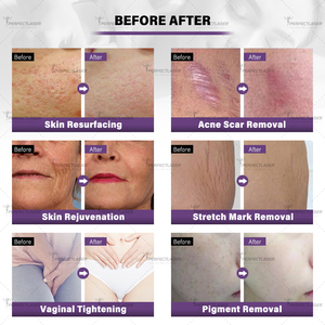 Equipo <span class=keywords><strong>de</strong></span> Belleza Perfectlaser <span class=keywords><strong>con</strong></span> Láser <span class=keywords><strong>de</strong></span> CO2 para Rejuvenecimiento <span class=keywords><strong>de</strong></span> la Piel, Reparación del Daño Solar y Eliminación <span class=keywords><strong>de</strong></span> Pigmentos - Product Image 6