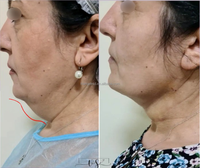 Diode laser 980 nm 60 W pour liposuccion, Vaser Lipo, lipolyse, équipement de chirurgie plastique, lifting endolaser
