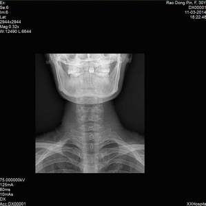 Портативный беспроводной цифровой рентгеновский детектор Iray X-Ray Machine (14*17 дюймов) для плоских панелей - Product Image 4