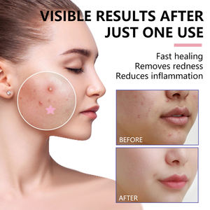 厂家批发面部粉刺贴剂，消除粉刺，减少发红，水杨酸面部粉刺贴剂 - Product Image 3