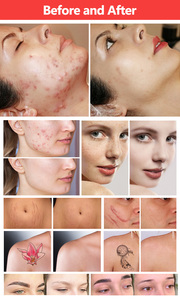 2 In 1 <b>Standing</b> Q-<b>Switched</b> Nd:Yag (1064 532 1320) Pigment Removal Equipment Pore Acne Treatment Adjustable - Product Image 4