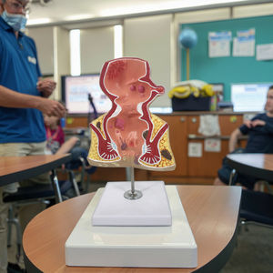 Modèle d'anatomie du rectum avec pathologies Modèle d'anatomie du rectum avec pathologies Démonstration de la maladie du rectum pour les sciences médicales - Product Image 2