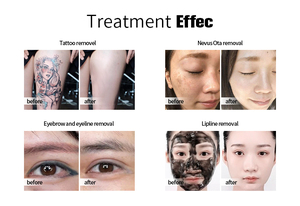 Machine laser picoseconde portable haute énergie 600 mJ sur chariot – Élimination rapide des tatouages et rajeunissement cutané pour cliniques esthétiques - Product Image 6
