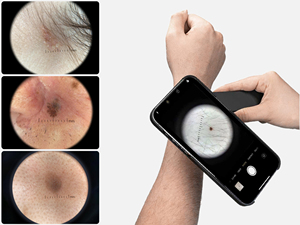 IBOOLO DE-4100 <span class=keywords><strong>Dermatoscopio</strong></span> Medico Avanzato Portatile con Ingrandimento 10X - Product Image 4