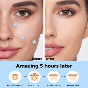 Patch anti-acné transparent rond invisible, aide à prévenir les cicatrices d'acné, adapté au maquillage quotidien, soin de la peau - Product Image 4