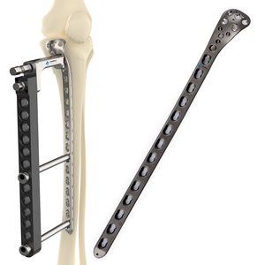 Placca Tibiale Proximale ad Angolo Variabile CANWELL 3.5 mm, Impianto Ortopedico per Trauma, Placca Ossea in Titanio CE ISO - Product Image 1