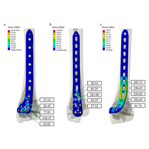 Implantes Ortopédicos Quirúrgicos Manuales de Titanio para Tibia Distal, con Bloqueo Intramedular Multidimensional, Eficaz para Traumatismos - Product Image 3