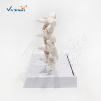 Modelo de Lesión de Osteoporosis en 2 Partes: Columna Vertebral y Fémur Proximal Patológicos, PVC Pintado a Mano, Ideal para la Educación del Paciente