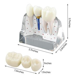 Modèle d'implant dentaire pour l'éducation des patients, modèle d'implant dentaire, de couronne et de pont 4 fois plus grand pour la présentation - Transparent - Product Image 6