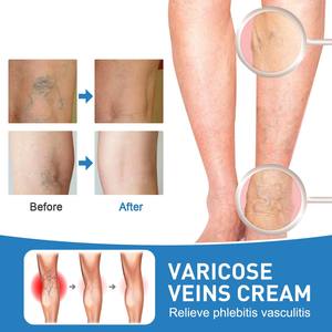 Diskon besar krim pijat intravena krim pereda penenang kaki pembuluh darah tonjolan pereda nyeri Choroid pijat pembuluh varises - Product Image 4