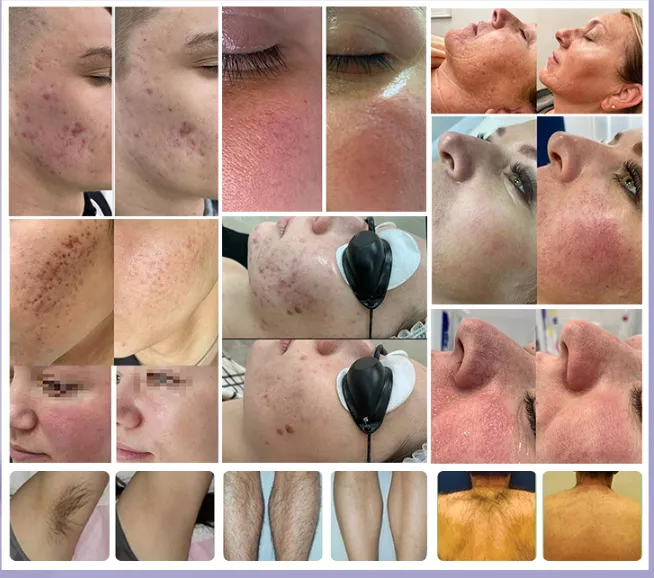 ipl hair removal before and after