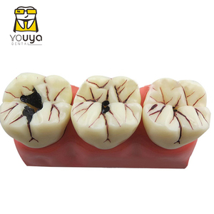 Chất lượng cao 4-lần nha khoa sâu răng phát triển mô hình giảng dạy nha khoa mô hình - Product Image 3