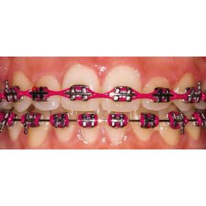 Nouveaux produits 2025, équipements de beauté dentaire, produits, brackets, faux appareils dentaires tendance pour les dents, appareil dentaire - Product Image 2