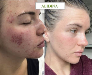 GZ 99% บำบัดด้วยไมโครนีดเดิลชีวภาพที่แข็งแกร่งที่สุด ด้วยเข็มสปองกิลล่า บำบัดด้วยไมโครนีดเดิลชีวภาพ กำจัดสิวอย่างเป็นธรรมชาติ <span class=keywords><strong>ไม่มี</strong></span>สารเคมีกรด - Product Image 6