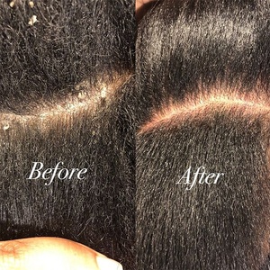 Shampoo anti-poux et anti-démangeaisons pour cheveux, marque privée, tue les poux et les œufs, traitement pour enfants et bébés - Product Image 2