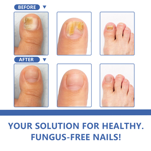 Tùy chỉnh nấm móng tay đổi mới tối đa sức mạnh undecylenic 25%, giết chết nấm, phục hồi và làm mới, bảo vệ khỏi tái nhiễm - Product Image 6