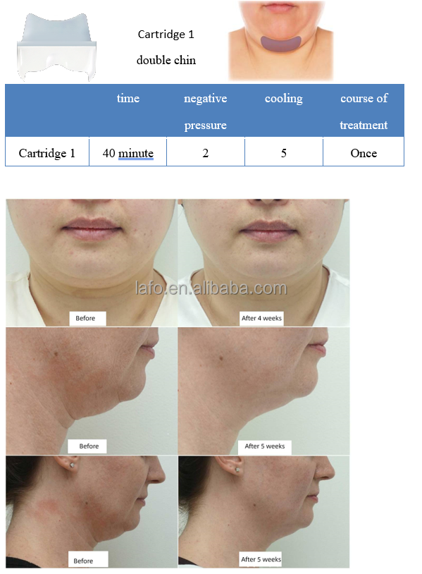 2022 360 cryolipolysis new technology professional body contouring fat reduce weight loss machine for sale LF-268