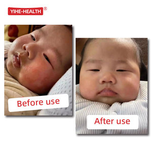 YIHE-HEALTH 피부 수리 크림 기저귀 발진 크림 어린이의 습진 - Product Image 4