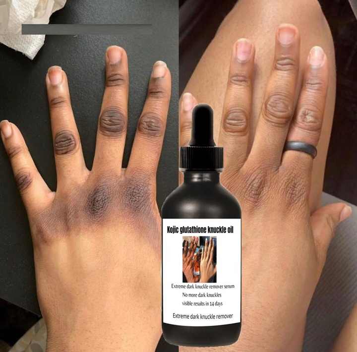 Dark Knuckles Remove Serum Strong Effective Knuckles Remover Removes Dark Dpots Whitening Serum For Dark Knuckle