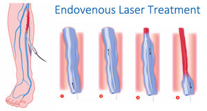 Minimaal Invasieve <span class=keywords><strong>980nm</strong></span> 1470nm Event Endovasculaire Spataderen Verwijderingslaserablatie-Apparaat 1470 Endolaser Radiale Vezel - Product Image 2