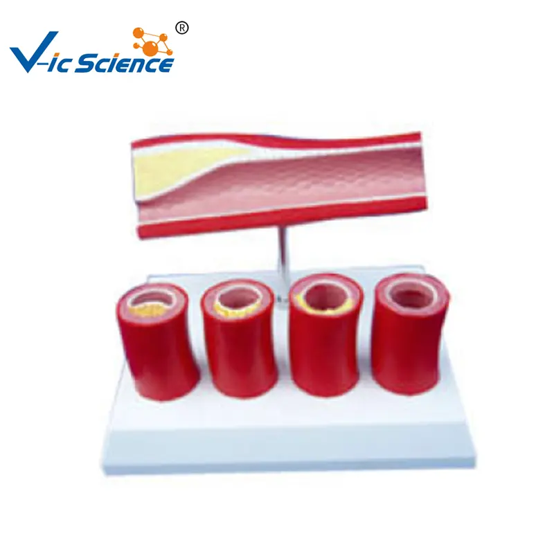 Human Anatomy Medicine Pathology Artery and Blood Vessel Pathology Model