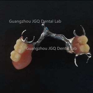 กรอบโลหะฟันปลอมบางส่วนที่ถอดออกได้ได้รับความนิยมมีความเสถียรและการเก็บรักษา (โคบอลต์และโครเมี่ยม) - Product Image 5