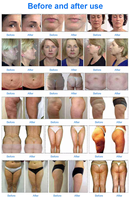 Rouleau de massage amincissant en acier inoxydable à rotation 9D avec ventouse pour drainage lymphatique et élimination de la cellulite