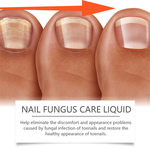 Ximonth 30ml Liquide de Soin des Ongles Contre les Mycoses avec Lime – Réduit l'Inconfort des Ongles des Pieds, Restaure la Santé et Nourrit les Ongles - Product Image 2
