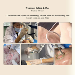 Máquina de Laser CO2 Portátil com Peças Manuais para Remoção de Cicatrizes e Estrias, Sistema de Aperto Vaginal Fracionado - Product Image 6