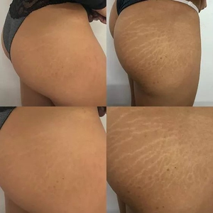 CO2 Fractional Laser Beauté Machine Professionnel Rides Cicatrice Enlèvement Rajeunissement De La Peau Carbone Peeling Portable - Product Image 5