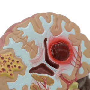 Modèle de <span class=keywords><strong>pathologie</strong></span> du cerveau humain avec hémorragie et malformation <span class=keywords><strong>vasculaire</strong></span> pour l'enseignement de l'anatomie - Product Image 5