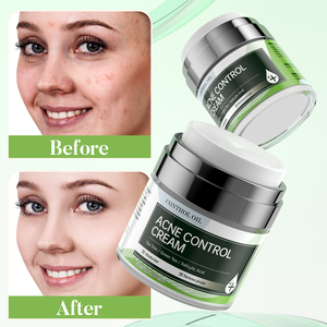 Meilleure crème pour enlever les cicatrices d'acné Crème anti-acné Crème hydratante pour le <span class=keywords><strong>visage</strong></span> Crème organique pour enlever les boutons d'acné - Product Image 3