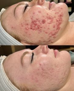 Meilleure vente masque raffermissant visage pour femmes poudre lyophilisée d'algues naturelles infusée d'acide hyaluronique sérum propre Bio Peeling - Product Image 5