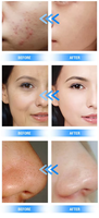 Nuevo 360 de 2026 °   Máquina de Oxígeno 6 en 1 para Limpieza Facial y Lifting Facial, Hidrodermoabrasión, Hidro Microdermoabrasión
